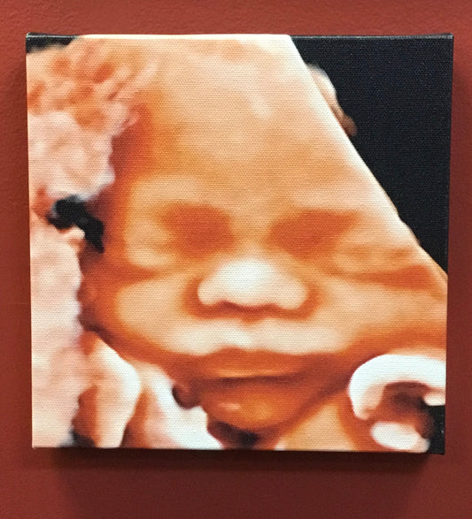 Canvas Ultrasound Photo