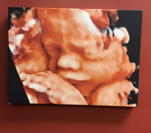 Canvas Ultrasound Photo